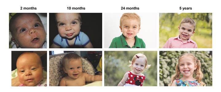 Photo Progression of child with Sanfilippo Syndrome and unaffected sibling; Paper "Development of a Clinical Algorithm for the Early Diagnosis of Mucopolysaccharidosis III"