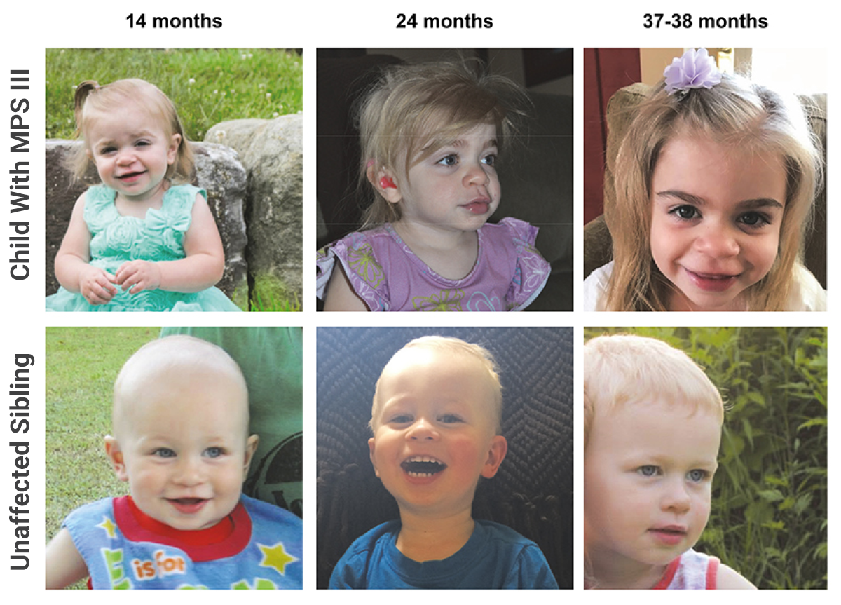 Facial features of girl with Sanfilippo, compared to sibling
